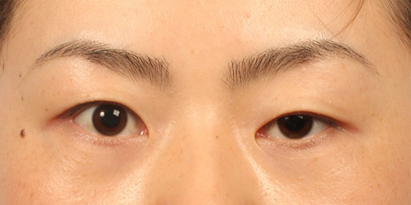 Phẫu thuật cắt mí mắt trên có ảnh hưởng thị lực 1