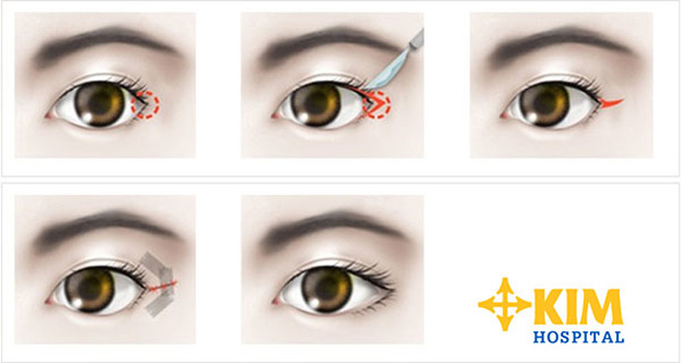 Điều bạn chưa biết về phẫu thuật thẩm mỹ mắt to 3