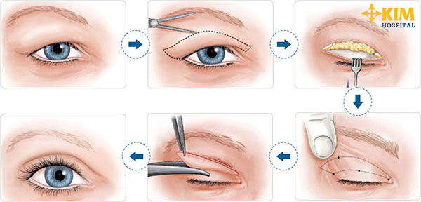 Phẫu thuật cắt mí mắt trên có ảnh hưởng thị lực 3
