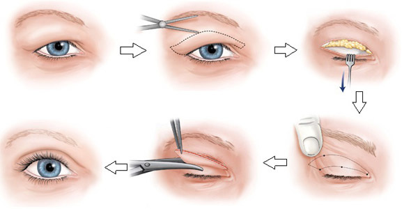 Mách bạn 5 cách chữa sụp mí mắt an toàn 3